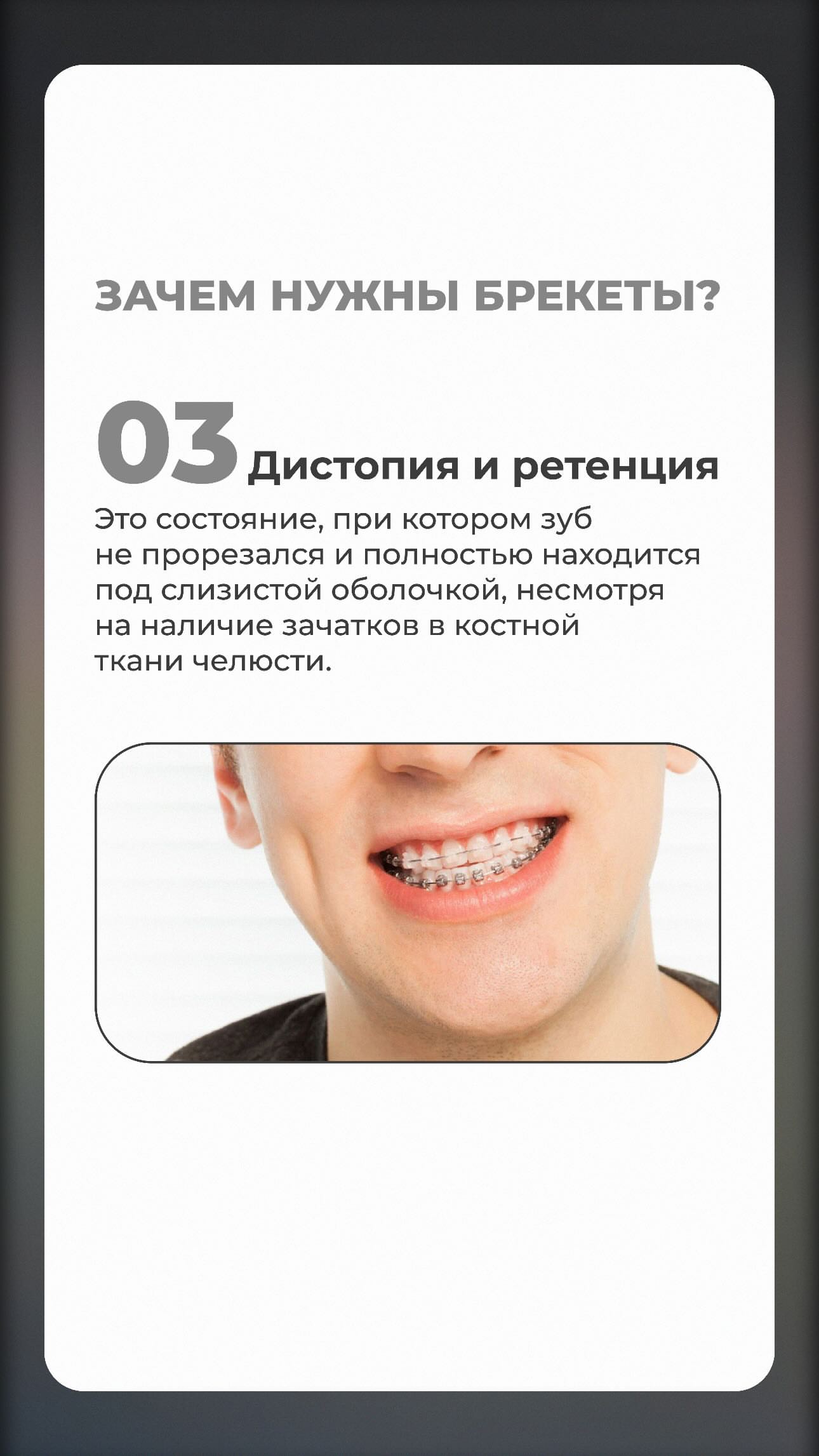 До: зубы до начала ортодонтического лечения