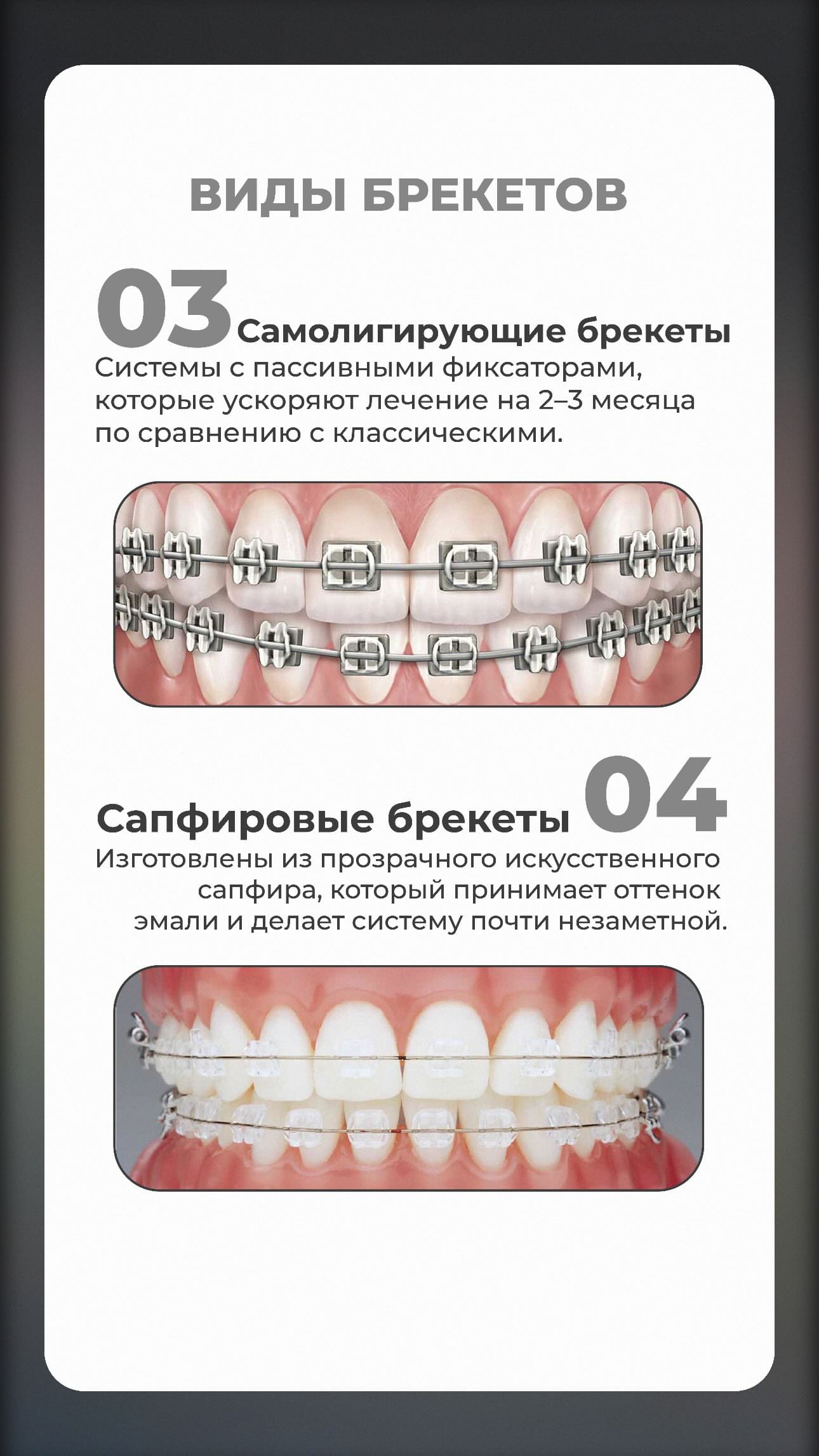 Брекеты — кейс