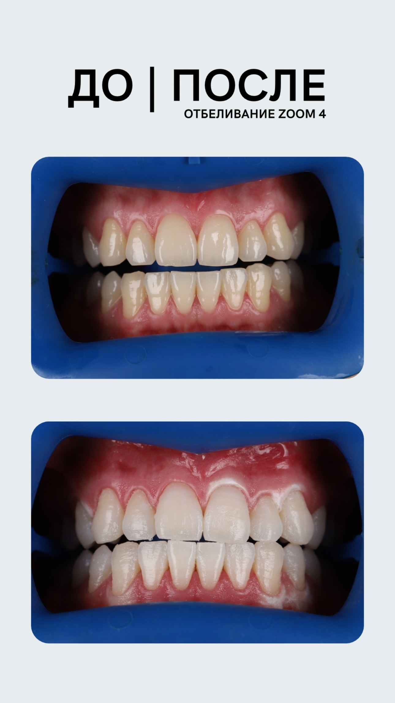 Отбеливание ZOOM 4