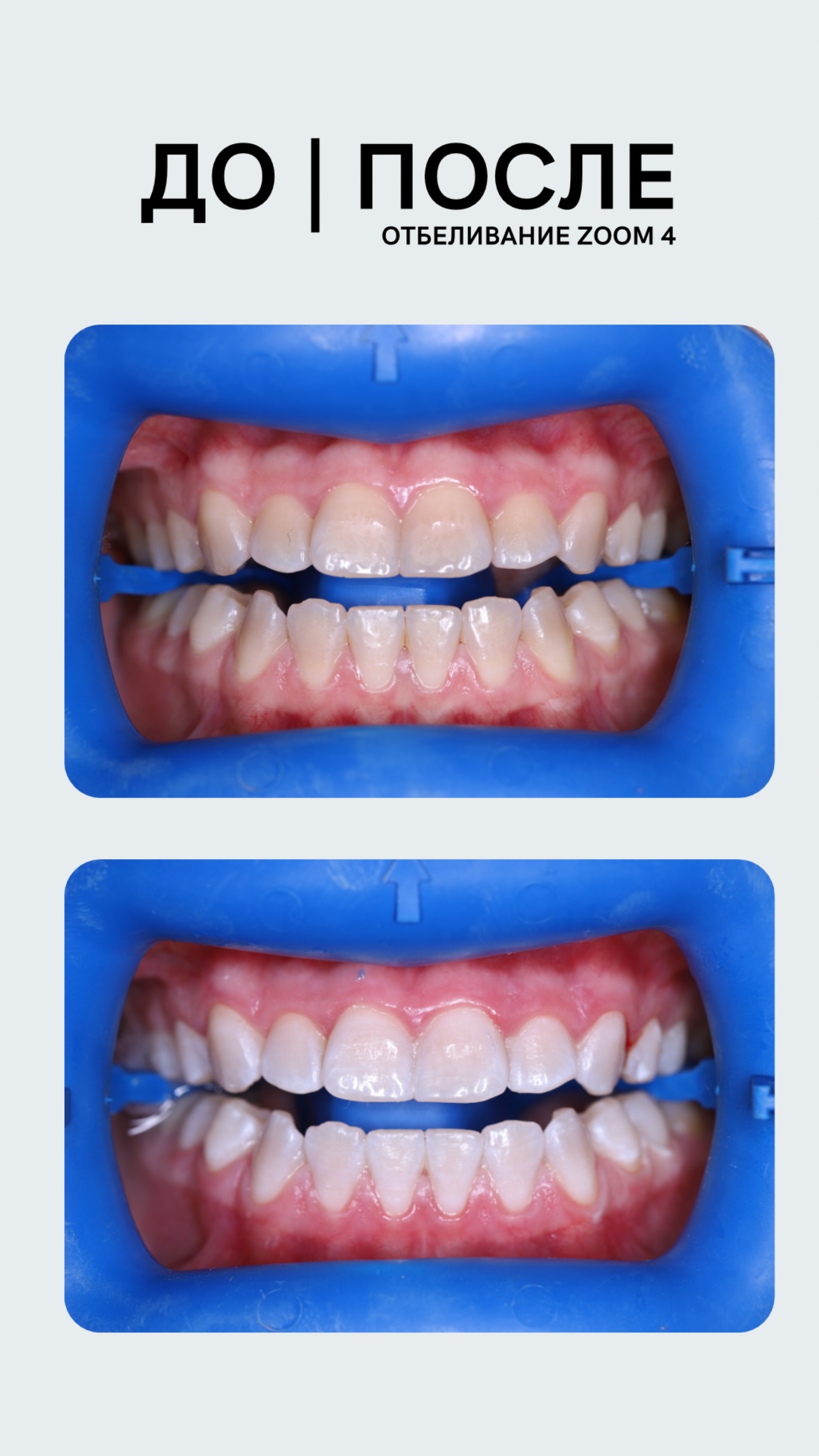 Отбеливание — кейс