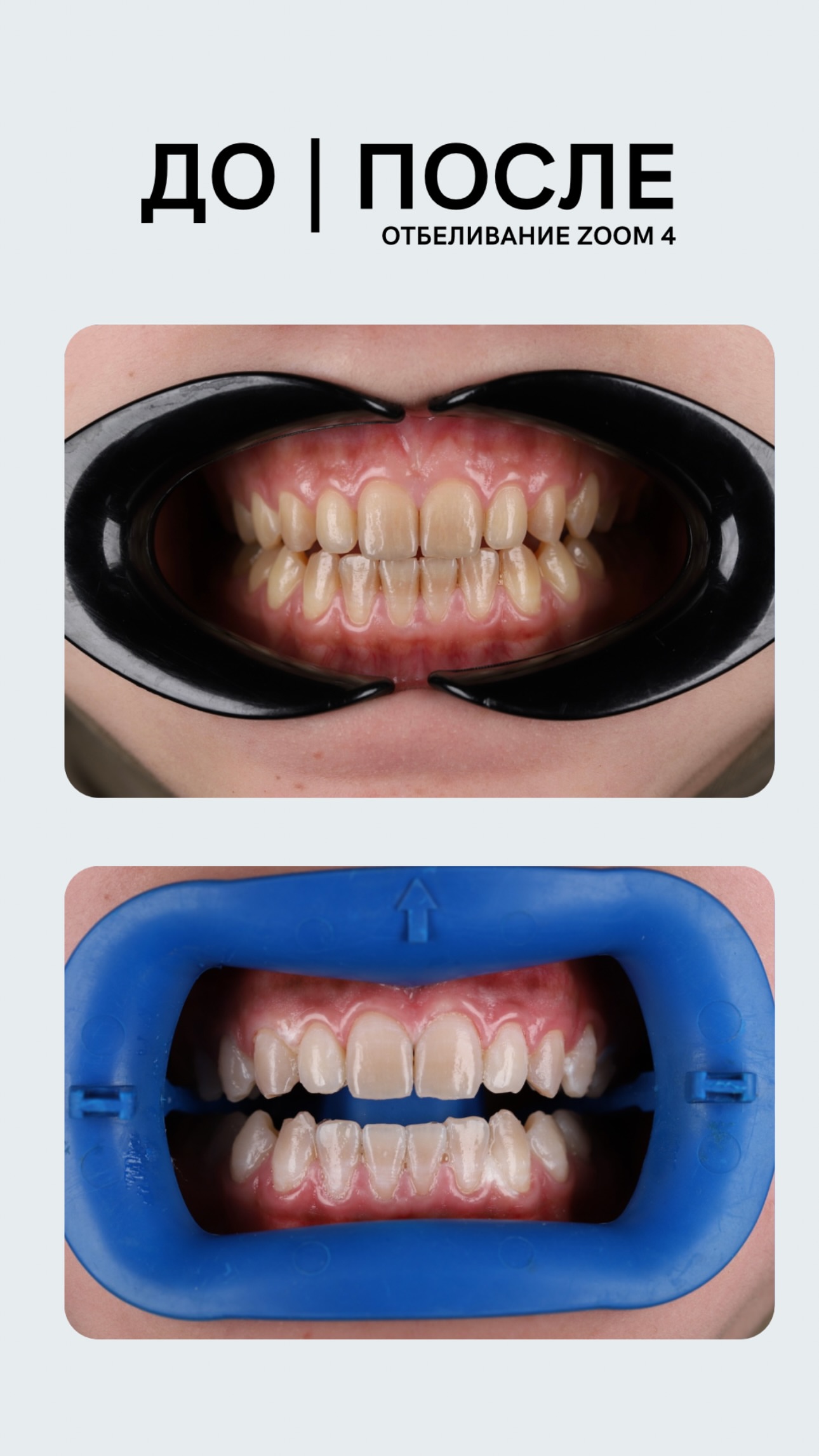 Отбеливание — кейс